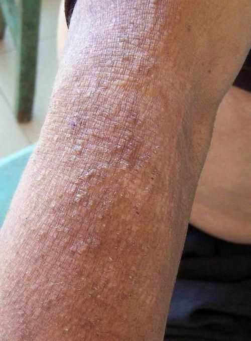 什么是皮膚淀粉樣變