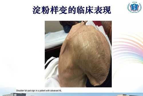 皮膚淀粉樣變的癥狀