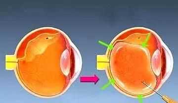 眼鏡可以帶上飛機嗎，五毫升的隱形眼鏡護理液可以隨身帶著上飛機嗎？圖7