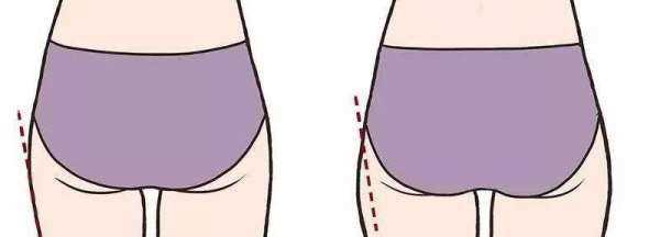 假胯寬矯正需要多久,假胯寬鍛煉幾個月能糾正過來圖2