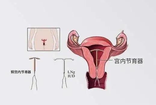 為什么不建議女人上環(huán)