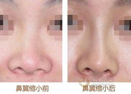 縮小鼻翼都有什么方法有哪些