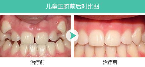 小兒牙齒矯正方法有哪些