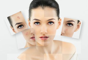 中醫(yī)祛痘去痘印的方法有哪些