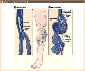 靜脈曲張有哪些更好的治療方法