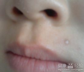 點痣后怎么修復最好方法有哪些