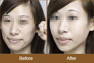 目前除皺有哪些方法是什么