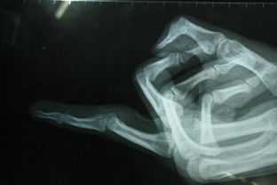 手關(guān)節(jié)軟組織挫傷怎么處理？(軟組織挫傷多久能好？)