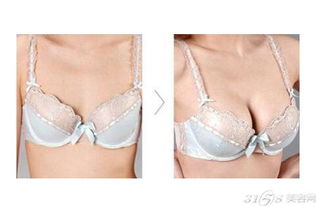硅膠豐胸注意事項(xiàng)