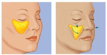 肌注,打了,事項,蘋果