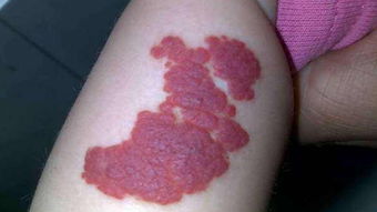 血管,激光,注意事項(xiàng)