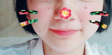 電燒法點痣的注意事項