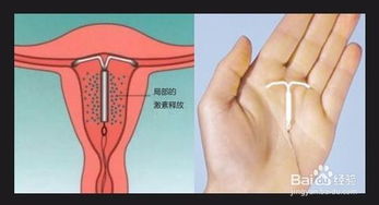 女性上完環(huán)注意事項,上完避孕環(huán)需要注意什么,上環(huán)后應(yīng)該注意什么事項