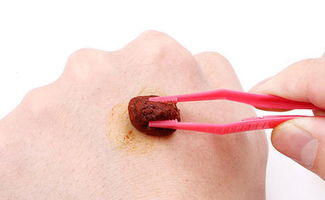 瘢痕灸的注意事項(xiàng),瘢痕子宮懷孕注意事項(xiàng),瘢痕子宮分娩注意事項(xiàng)