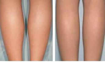 脂肪豐胸術(shù)后注意事項(xiàng),脂肪填充術(shù)后注意事項(xiàng),面部脂肪填充術(shù)后注意事項(xiàng)