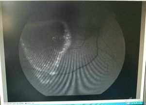 造影,眼科,注意事項