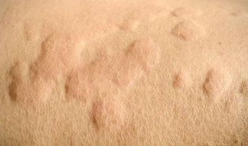 玫瑰糠疹洗澡注意事項(xiàng)