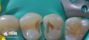 寶寶補(bǔ)牙后注意事項