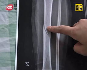 腳趾,骨折,注意事項(xiàng),兒童