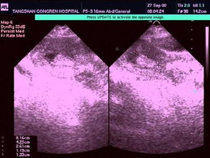 息肉,注意事項(xiàng)