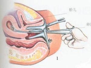 墮胎前的注意事項(xiàng),流產(chǎn)手術(shù)術(shù)前注意事項(xiàng),流產(chǎn)手術(shù)后的注意事項(xiàng)