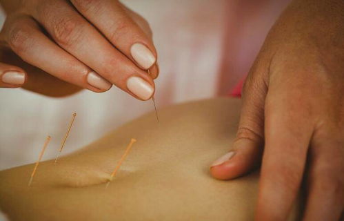 針灸肚子需要注意事項(xiàng)