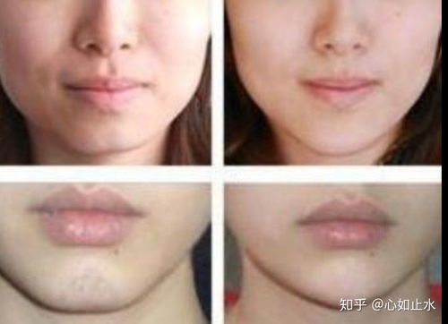 隆下巴術(shù)后注意事項