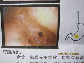 疣狀胃炎術(shù)后注意事項(xiàng)