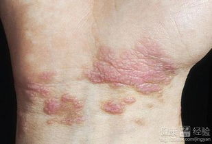 足蘚注意事項,腳蘚注意事項,花斑癬注意事項