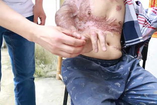 瘢痕攣縮注意事項(xiàng)