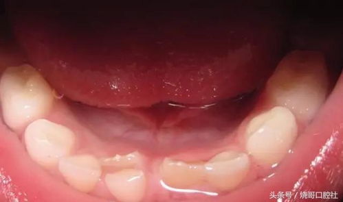 兒童補(bǔ)牙后注意事項有哪些,小孩補(bǔ)牙后注意事項,補(bǔ)牙后的注意事項