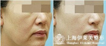 注射,注意事項,botox,去川字紋