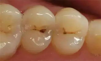 補(bǔ)牙后注意事項(xiàng)拔牙