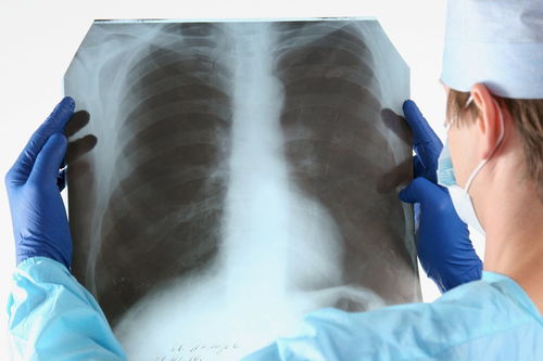 氣胸康復(fù)后注意事項