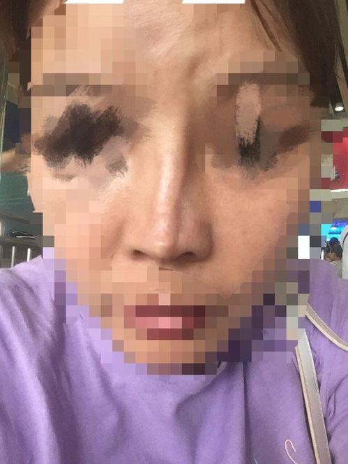 隆鼻術(shù)后的10大注意事項(xiàng),隆鼻術(shù)后飲食注意事項(xiàng),肋骨隆鼻術(shù)后注意事項(xiàng)