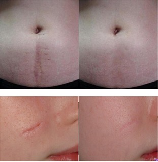 去疤針注意事項,打完去疤針注意事項,去圖書館的注意事項