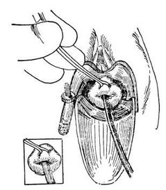 微管可視無痛人流術(shù)前注意事項