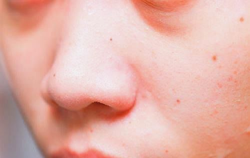 鼻頭縮小注意事項(xiàng),鼻頭縮小術(shù)后注意事項(xiàng),鼻頭打軟化針注意事項(xiàng)