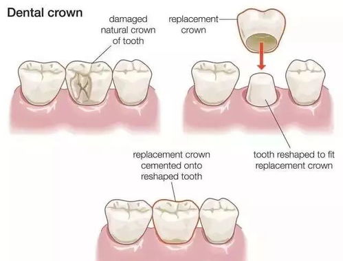 根管填充后注意事項(xiàng)