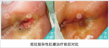 艾滋病做肛瘺手術(shù)后注意事項