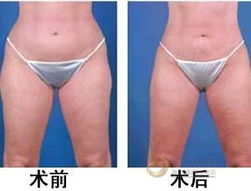 術(shù)后,腰部,注意事項(xiàng),吸脂