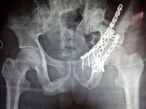 髖臼復(fù)位后注意事項