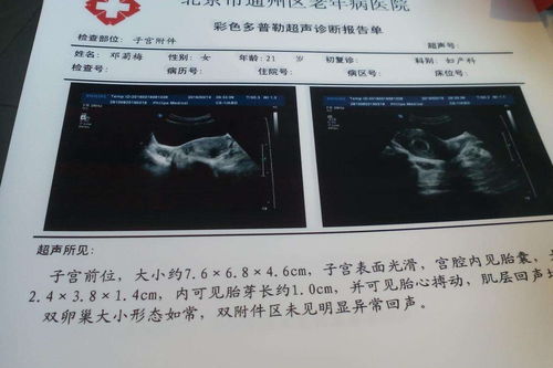 婚前,注意事項(xiàng),時(shí)間,孕檢