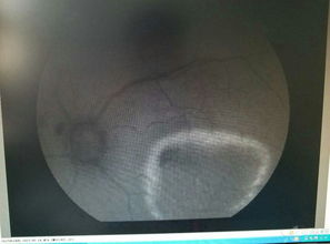 輸卵管造影做完后注意事項,碘海醇造影后注意事項,輸卵管造影后的注意事項