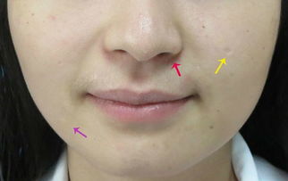 手術(shù)去黑痣前注意事項(xiàng)