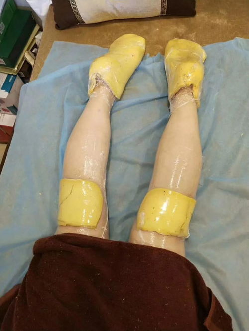 蠟療,病人,注意事項(xiàng)