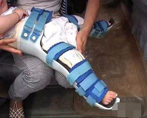 兒童腳趾骨折后注意事項(xiàng),腳趾骨折護(hù)理注意事項(xiàng),腳趾骨折術(shù)后注意事項(xiàng)